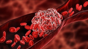 Covid-19 povećava rizik od ugrušaka krvi do šest mjeseci poslije zaraze